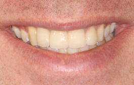 Smile Gallery - Church Road Dental and Cosmetic