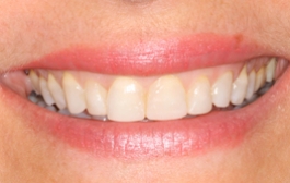 Smile Gallery - Church Road Dental and Cosmetic