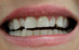 Smile Gallery - Church Road Dental and Cosmetic