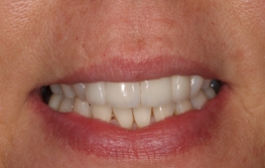 Smile Gallery - Church Road Dental and Cosmetic
