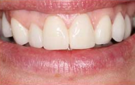 Smile Gallery - Church Road Dental and Cosmetic