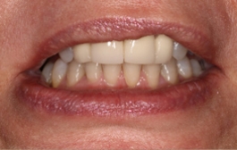 Smile Gallery - Church Road Dental and Cosmetic