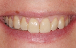 Smile Gallery - Church Road Dental and Cosmetic