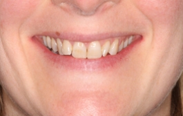 Smile Gallery - Church Road Dental and Cosmetic