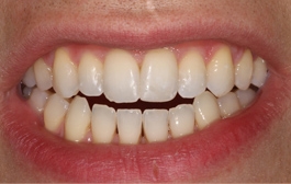 Smile Gallery - Church Road Dental and Cosmetic