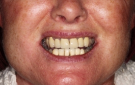 Smile Gallery - Church Road Dental and Cosmetic