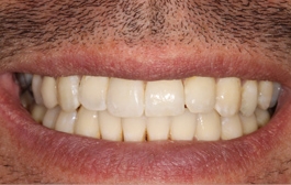 Smile Gallery - Church Road Dental and Cosmetic