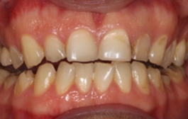Smile Gallery - Church Road Dental and Cosmetic
