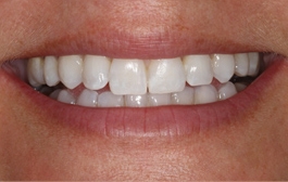 Smile Gallery - Church Road Dental and Cosmetic