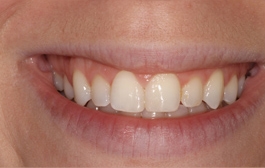 Smile Gallery - Church Road Dental and Cosmetic