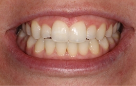 Smile Gallery - Church Road Dental and Cosmetic