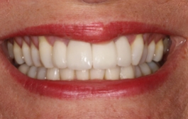 Smile Gallery - Church Road Dental and Cosmetic