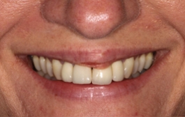 Smile Gallery - Church Road Dental and Cosmetic