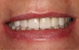 Smile Gallery - Church Road Dental and Cosmetic