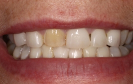 Smile Gallery - Church Road Dental and Cosmetic
