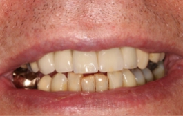 Smile Gallery - Church Road Dental and Cosmetic