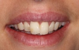 Smile Gallery - Church Road Dental and Cosmetic