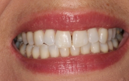 Smile Gallery - Church Road Dental and Cosmetic