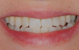 Smile Gallery - Church Road Dental and Cosmetic