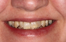 Smile Gallery - Church Road Dental and Cosmetic