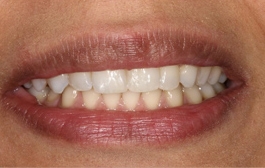 Smile Gallery - Church Road Dental and Cosmetic