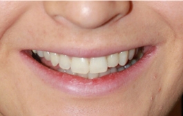 Smile Gallery - Church Road Dental and Cosmetic