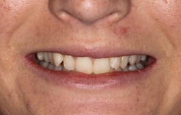 Smile Gallery - Church Road Dental and Cosmetic