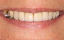 Smile Gallery - Church Road Dental and Cosmetic