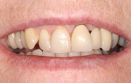 Smile Gallery - Church Road Dental and Cosmetic