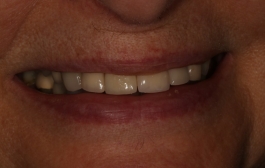 Smile Gallery - Church Road Dental and Cosmetic