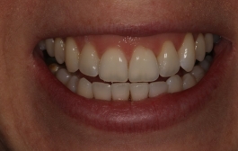 Smile Gallery - Church Road Dental and Cosmetic
