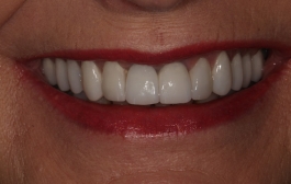 Smile Gallery - Church Road Dental and Cosmetic