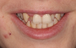 Smile Gallery - Church Road Dental and Cosmetic
