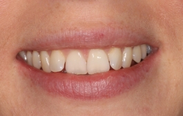 Smile Gallery - Church Road Dental and Cosmetic