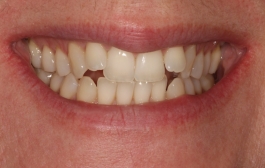Smile Gallery - Church Road Dental and Cosmetic