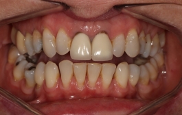 Smile Gallery - Church Road Dental and Cosmetic