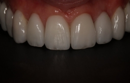 Smile Gallery - Church Road Dental and Cosmetic