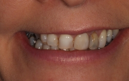 Smile Gallery - Church Road Dental and Cosmetic