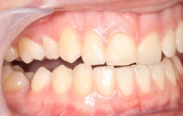 Smile Gallery - Church Road Dental and Cosmetic