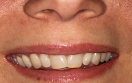 Smile Gallery - Church Road Dental and Cosmetic