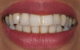 Smile Gallery - Church Road Dental and Cosmetic