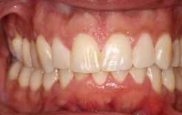 Smile Gallery - Church Road Dental and Cosmetic