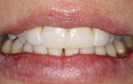 Smile Gallery - Church Road Dental and Cosmetic
