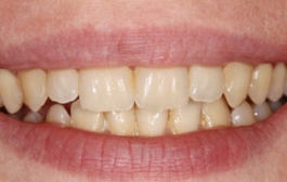 Smile Gallery - Church Road Dental and Cosmetic