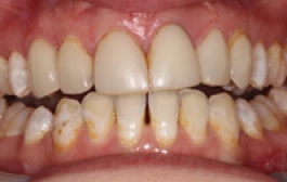 Smile Gallery - Church Road Dental and Cosmetic