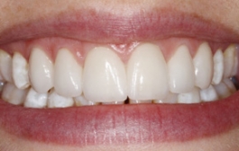 Smile Gallery - Church Road Dental and Cosmetic