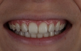 Smile Gallery - Church Road Dental and Cosmetic