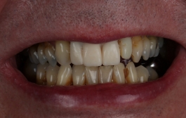 Smile Gallery - Church Road Dental and Cosmetic