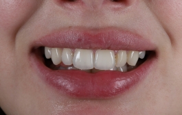 Smile Gallery - Church Road Dental and Cosmetic