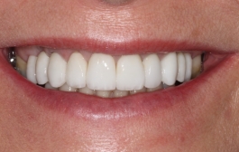 Smile Gallery - Church Road Dental and Cosmetic